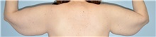Arm Lift Before Photo by Keyian Paydar, MD, FACS; Newport Beach, CA - Case 51206