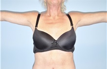 Arm Lift After Photo by Keyian Paydar, MD, FACS; Newport Beach, CA - Case 51204