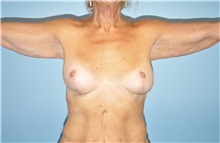 Arm Lift Before Photo by Keyian Paydar, MD, FACS; Newport Beach, CA - Case 51204