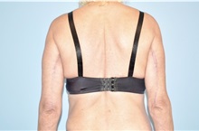Arm Lift After Photo by Keyian Paydar, MD, FACS; Newport Beach, CA - Case 51204