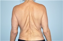 Arm Lift Before Photo by Keyian Paydar, MD, FACS; Newport Beach, CA - Case 51204