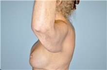Arm Lift Before Photo by Keyian Paydar, MD, FACS; Newport Beach, CA - Case 51204