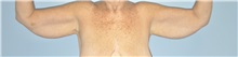 Arm Lift Before Photo by Keyian Paydar, MD, FACS; Newport Beach, CA - Case 51209