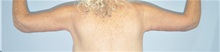 Arm Lift After Photo by Keyian Paydar, MD, FACS; Newport Beach, CA - Case 51209