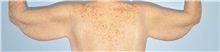 Arm Lift Before Photo by Keyian Paydar, MD, FACS; Newport Beach, CA - Case 51209