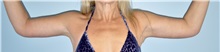 Arm Lift After Photo by Keyian Paydar, MD, FACS; Newport Beach, CA - Case 51207
