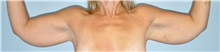 Arm Lift Before Photo by Keyian Paydar, MD, FACS; Newport Beach, CA - Case 51207