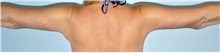 Arm Lift After Photo by Keyian Paydar, MD, FACS; Newport Beach, CA - Case 51207