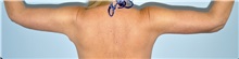 Arm Lift After Photo by Keyian Paydar, MD, FACS; Newport Beach, CA - Case 51207