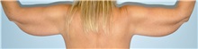 Arm Lift Before Photo by Keyian Paydar, MD, FACS; Newport Beach, CA - Case 51207
