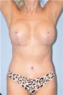 Body Contouring After Photo by Keyian Paydar, MD, FACS; Newport Beach, CA - Case 51218