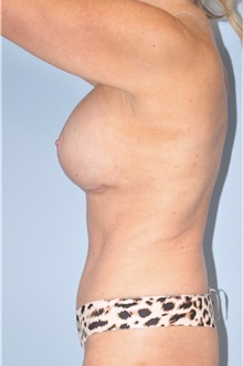 Body Contouring After Photo by Keyian Paydar, MD, FACS; Newport Beach, CA - Case 51218