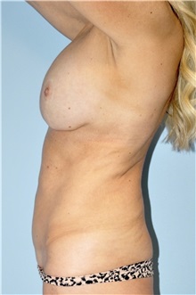 Body Contouring Before Photo by Keyian Paydar, MD, FACS; Newport Beach, CA - Case 51218