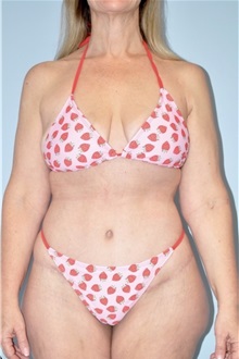 Body Contouring After Photo by Keyian Paydar, MD, FACS; Newport Beach, CA - Case 51217