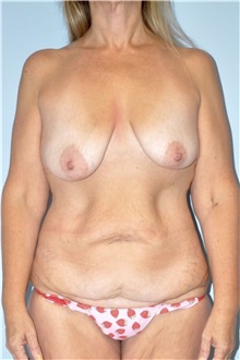 Body Contouring Before Photo by Keyian Paydar, MD, FACS; Newport Beach, CA - Case 51217