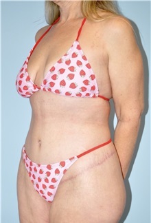 Body Contouring After Photo by Keyian Paydar, MD, FACS; Newport Beach, CA - Case 51217