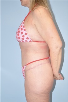 Body Contouring After Photo by Keyian Paydar, MD, FACS; Newport Beach, CA - Case 51217