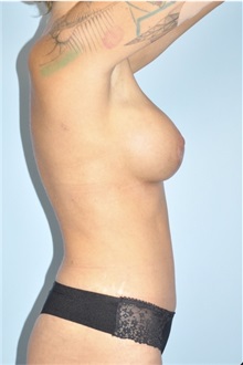 Body Contouring After Photo by Keyian Paydar, MD, FACS; Newport Beach, CA - Case 51227