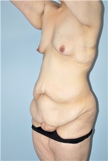 Body Contouring Before Photo by Keyian Paydar, MD, FACS; Newport Beach, CA - Case 51215