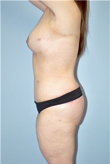 Body Contouring After Photo by Keyian Paydar, MD, FACS; Newport Beach, CA - Case 51215