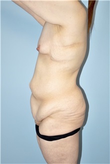 Body Contouring Before Photo by Keyian Paydar, MD, FACS; Newport Beach, CA - Case 51215