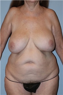 Body Contouring Before Photo by Keyian Paydar, MD, FACS; Newport Beach, CA - Case 51216