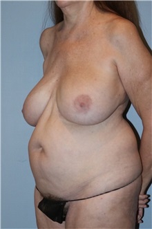 Body Contouring Before Photo by Keyian Paydar, MD, FACS; Newport Beach, CA - Case 51216