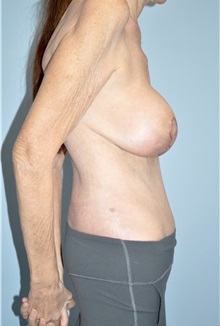 Body Contouring After Photo by Keyian Paydar, MD, FACS; Newport Beach, CA - Case 51216