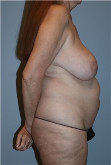 Body Contouring Before Photo by Keyian Paydar, MD, FACS; Newport Beach, CA - Case 51216
