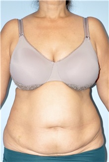 Body Contouring Before Photo by Keyian Paydar, MD, FACS; Newport Beach, CA - Case 51224