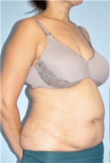 Body Contouring Before Photo by Keyian Paydar, MD, FACS; Newport Beach, CA - Case 51224