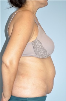 Body Contouring Before Photo by Keyian Paydar, MD, FACS; Newport Beach, CA - Case 51224