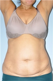 Body Contouring Before Photo by Keyian Paydar, MD, FACS; Newport Beach, CA - Case 51224