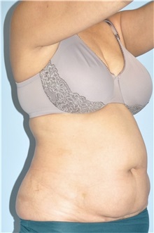 Body Contouring Before Photo by Keyian Paydar, MD, FACS; Newport Beach, CA - Case 51224