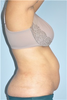 Body Contouring Before Photo by Keyian Paydar, MD, FACS; Newport Beach, CA - Case 51224