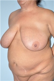 Body Contouring Before Photo by Keyian Paydar, MD, FACS; Newport Beach, CA - Case 51232