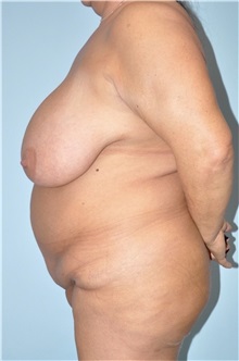 Body Contouring Before Photo by Keyian Paydar, MD, FACS; Newport Beach, CA - Case 51232