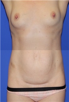 Body Contouring Before Photo by Keyian Paydar, MD, FACS; Newport Beach, CA - Case 51239