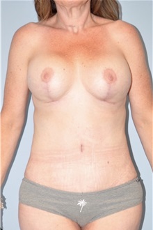 Body Contouring After Photo by Keyian Paydar, MD, FACS; Newport Beach, CA - Case 51221