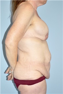 Body Contouring Before Photo by Keyian Paydar, MD, FACS; Newport Beach, CA - Case 51221
