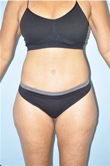 Body Contouring After Photo by Keyian Paydar, MD, FACS; Newport Beach, CA - Case 51212