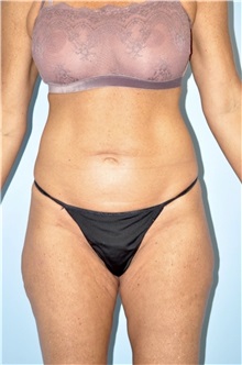 Body Contouring Before Photo by Keyian Paydar, MD, FACS; Newport Beach, CA - Case 51212