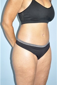Body Contouring After Photo by Keyian Paydar, MD, FACS; Newport Beach, CA - Case 51212