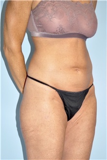 Body Contouring Before Photo by Keyian Paydar, MD, FACS; Newport Beach, CA - Case 51212