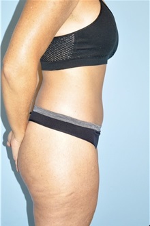 Body Contouring After Photo by Keyian Paydar, MD, FACS; Newport Beach, CA - Case 51212