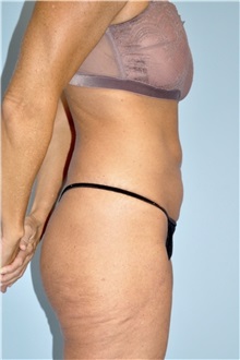 Body Contouring Before Photo by Keyian Paydar, MD, FACS; Newport Beach, CA - Case 51212
