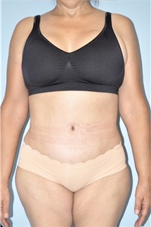 Body Contouring After Photo by Keyian Paydar, MD, FACS; Newport Beach, CA - Case 51223