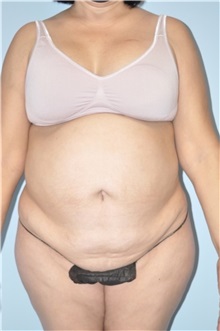 Body Contouring Before Photo by Keyian Paydar, MD, FACS; Newport Beach, CA - Case 51223