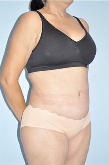 Body Contouring After Photo by Keyian Paydar, MD, FACS; Newport Beach, CA - Case 51223