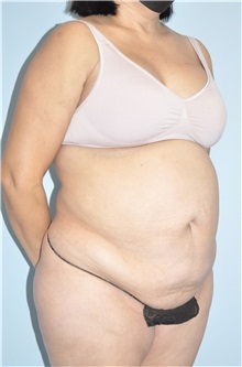 Body Contouring Before Photo by Keyian Paydar, MD, FACS; Newport Beach, CA - Case 51223